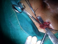 VERICOCELOCTOMY 3