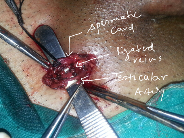 VERICOCELOCTOMY